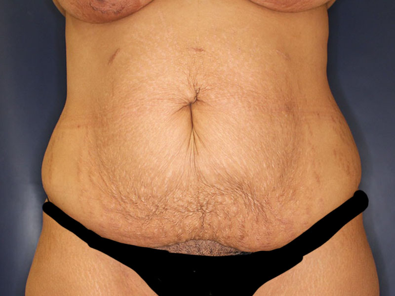 Tummy Tuck Before & After Image