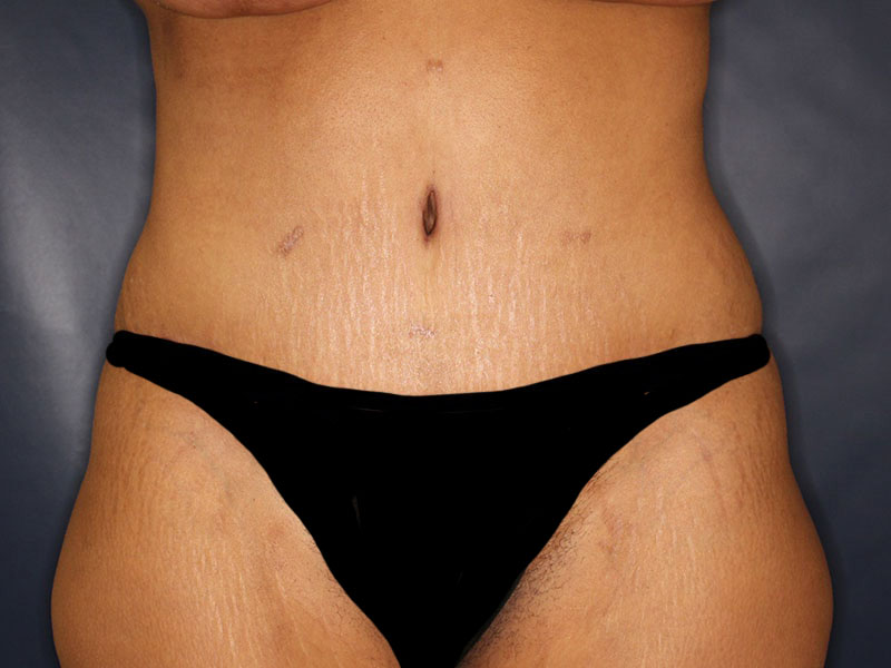 Tummy Tuck Before & After Image