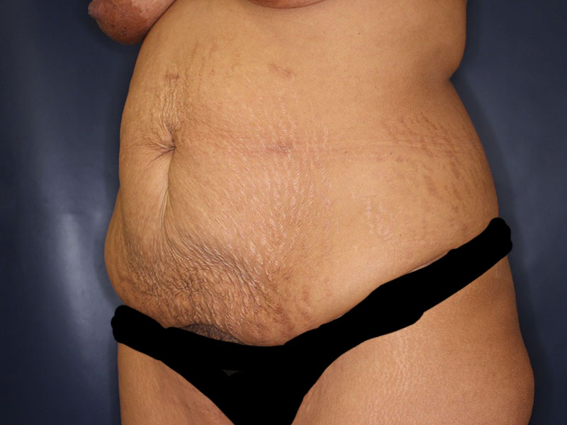 Tummy Tuck Before & After Image