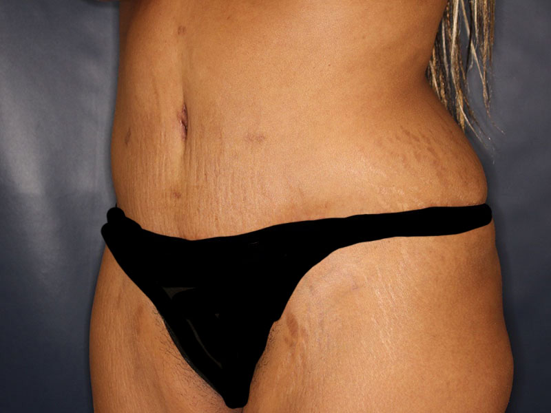 Tummy Tuck Before & After Image