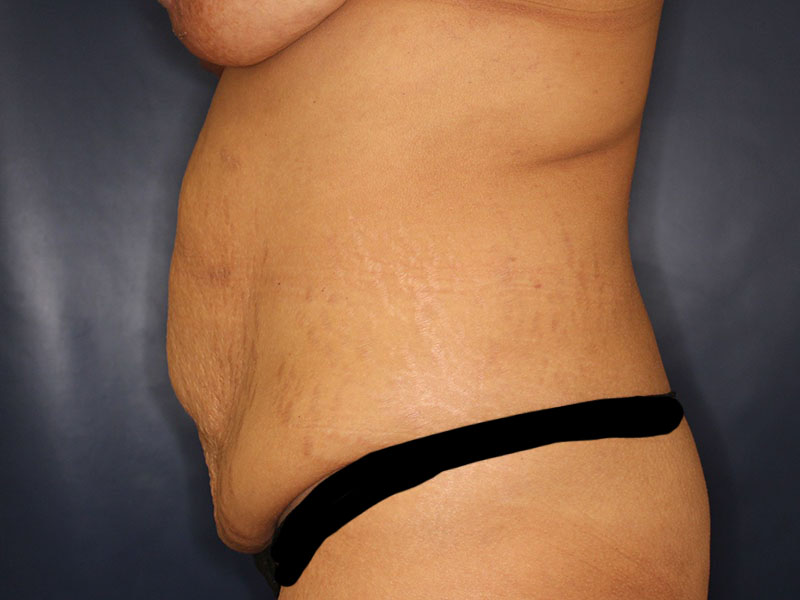 Tummy Tuck Before & After Image