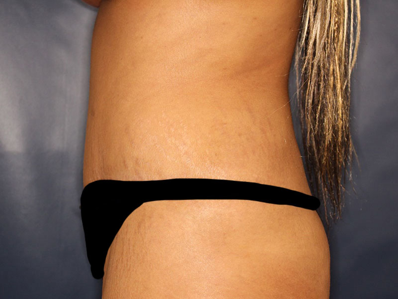 Tummy Tuck Before & After Image