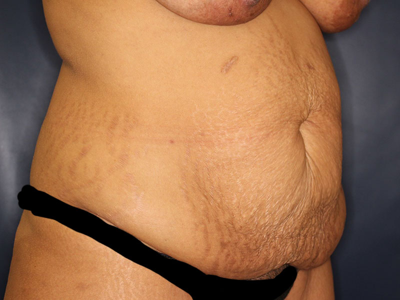 Tummy Tuck Before & After Image