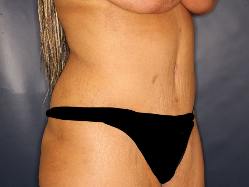 Tummy Tuck Before & After Image