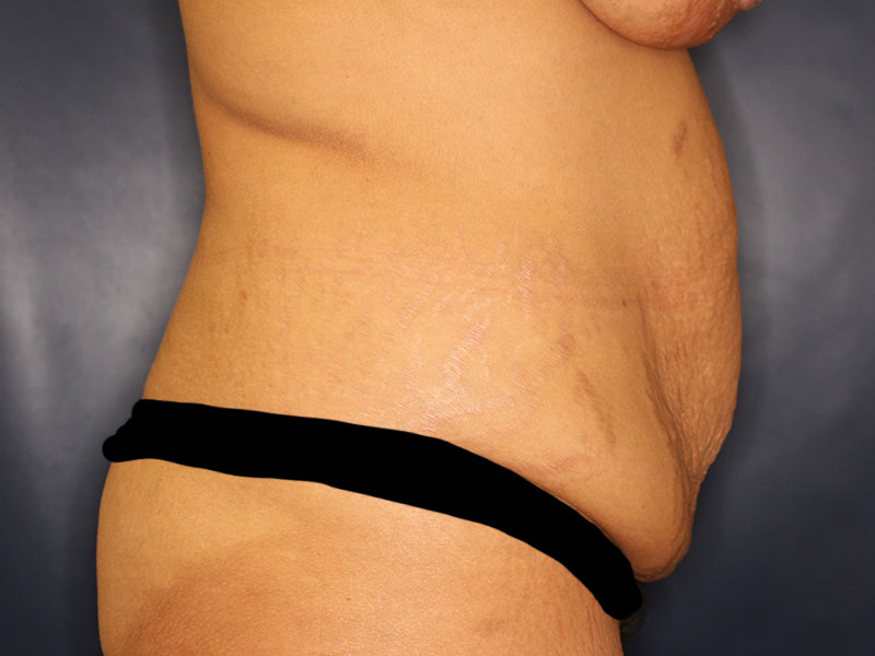 Tummy Tuck Before & After Image