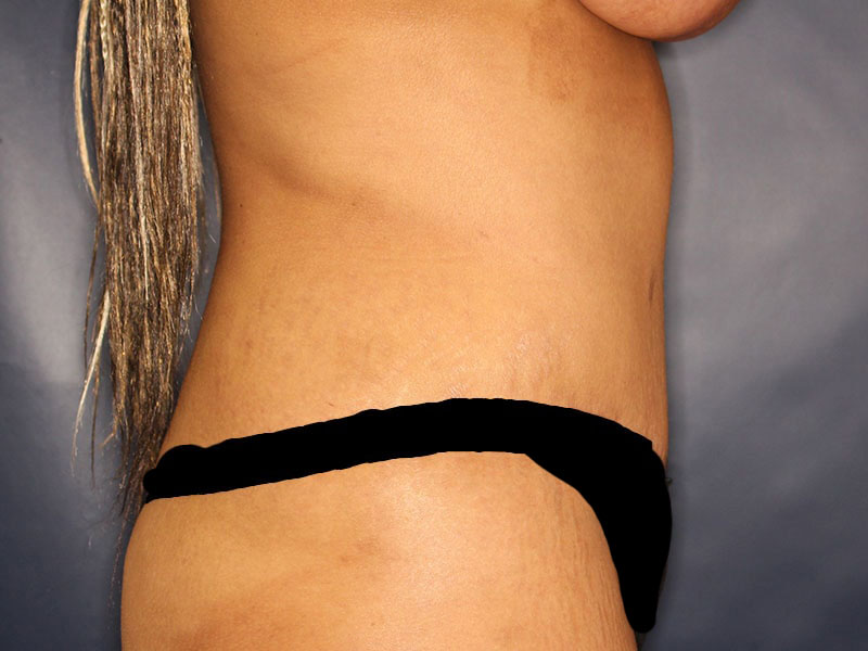 Tummy Tuck Before & After Image