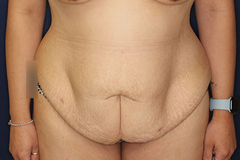 Tummy Tuck Before & After Image