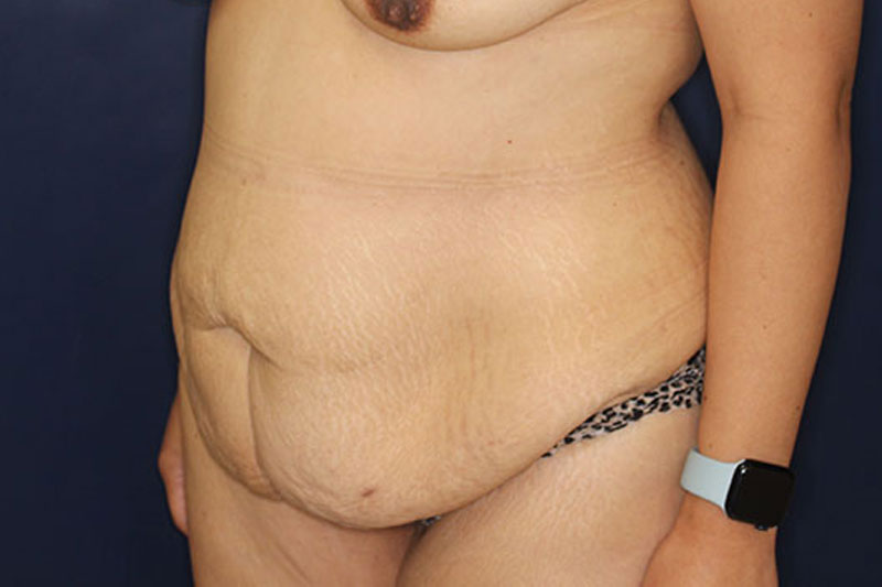 Tummy Tuck Before & After Image