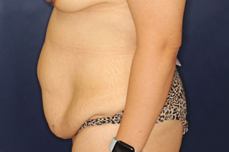 Tummy Tuck Before & After Image