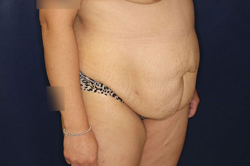 Tummy Tuck Before & After Image