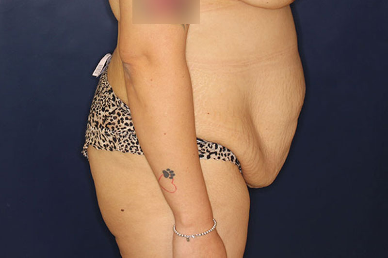 Tummy Tuck Before & After Image