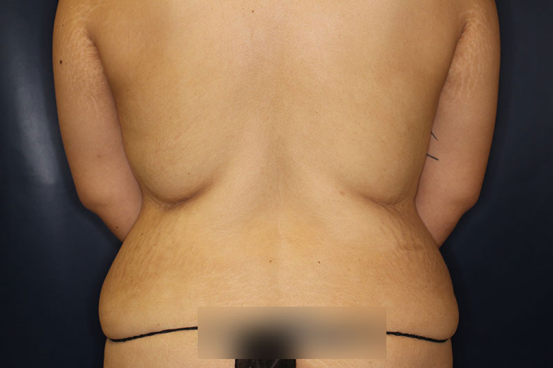 Tummy Tuck Before & After Image