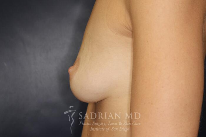 Breast Augmentation Before & After Image