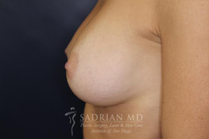 Breast Augmentation Before & After Image