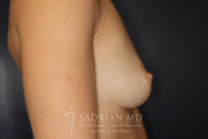 Breast Augmentation Before & After Image