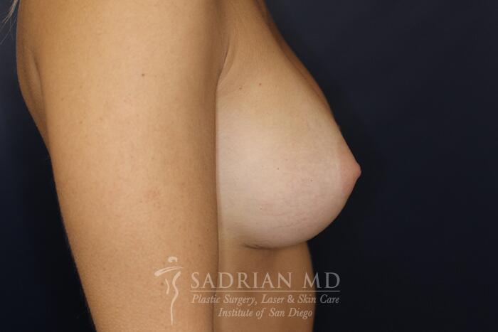 Breast Augmentation Before & After Image