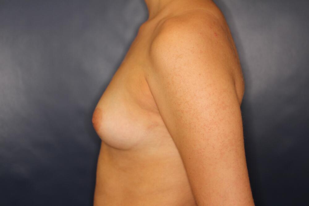 Breast Augmentation Before & After Image