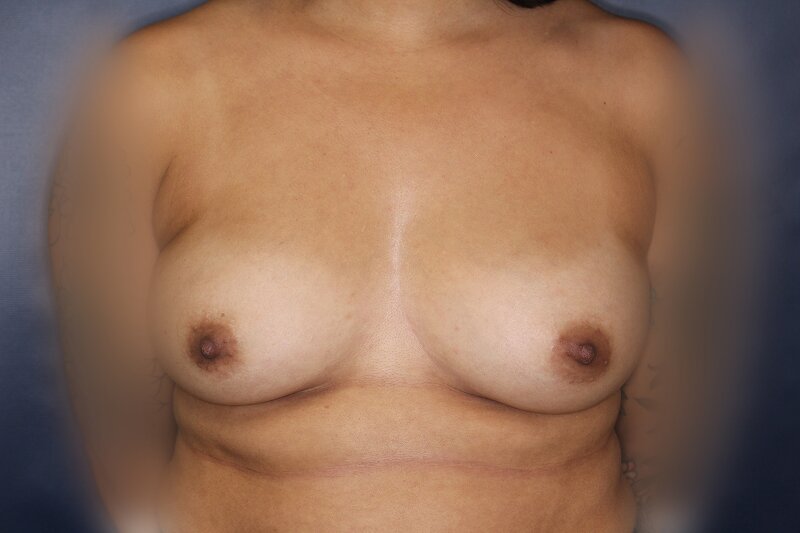 Breast Augmentation Before & After Image