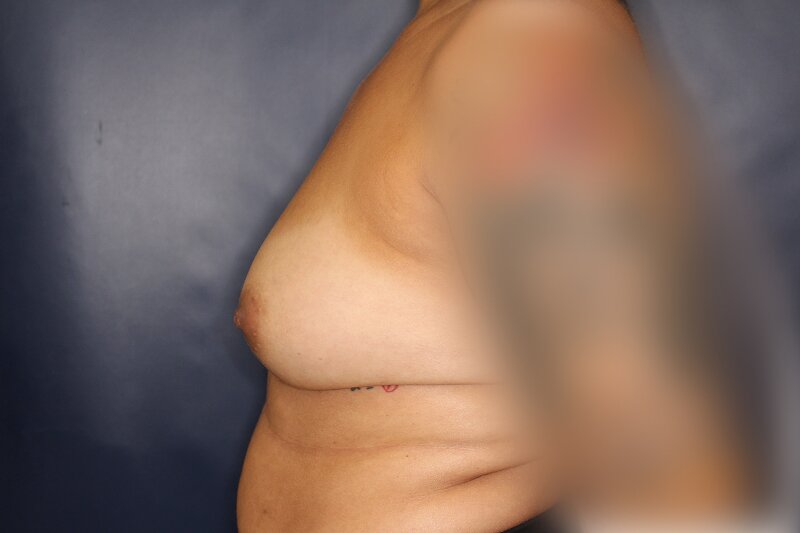 Breast Augmentation Before & After Image