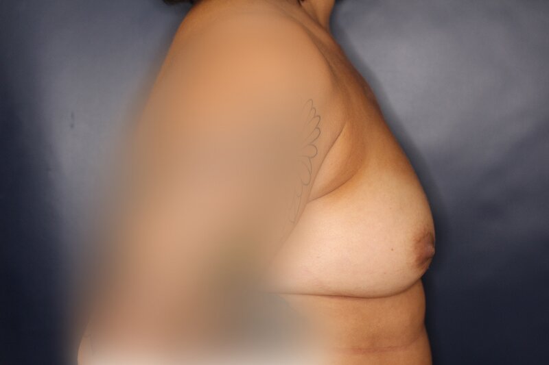 Breast Augmentation Before & After Image