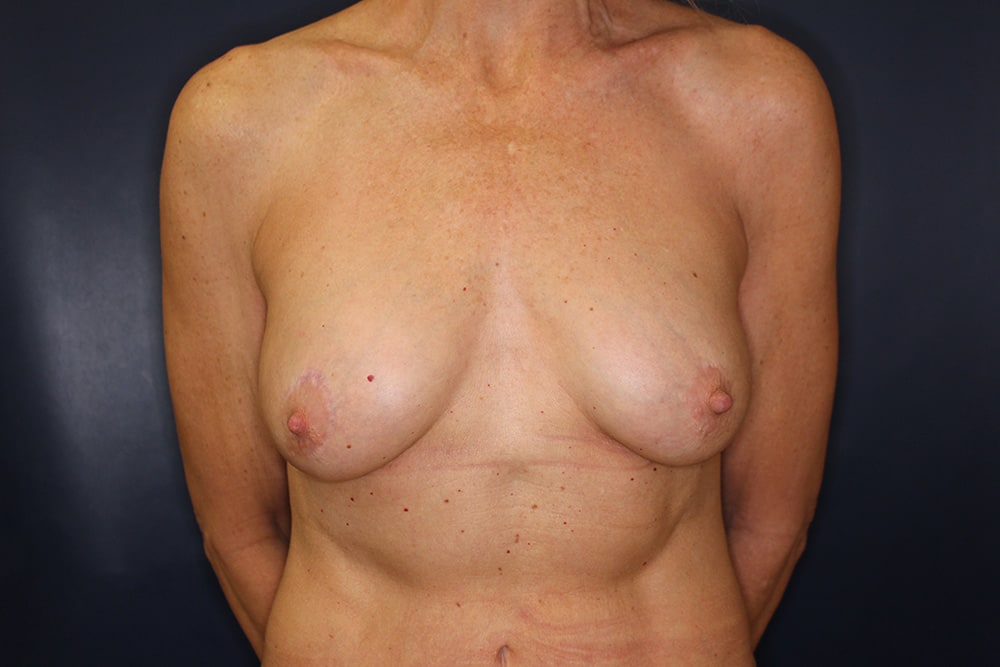 Breast Fat Transfer Before & After Image