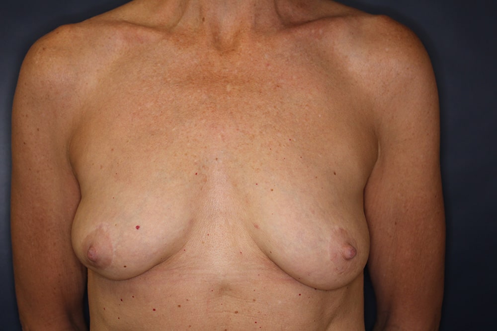 Breast Fat Transfer Before & After Image