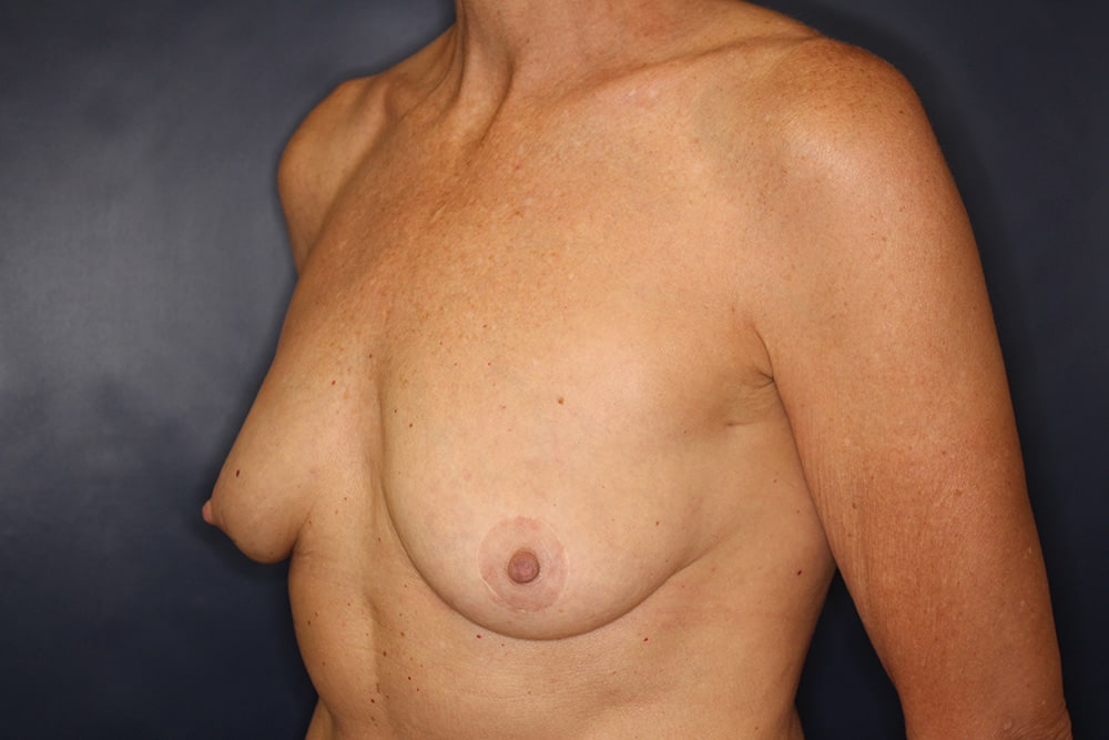 Breast Fat Transfer Before & After Image