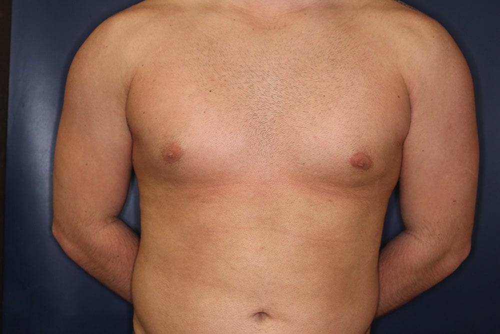 Gynecomastia Before & After Image