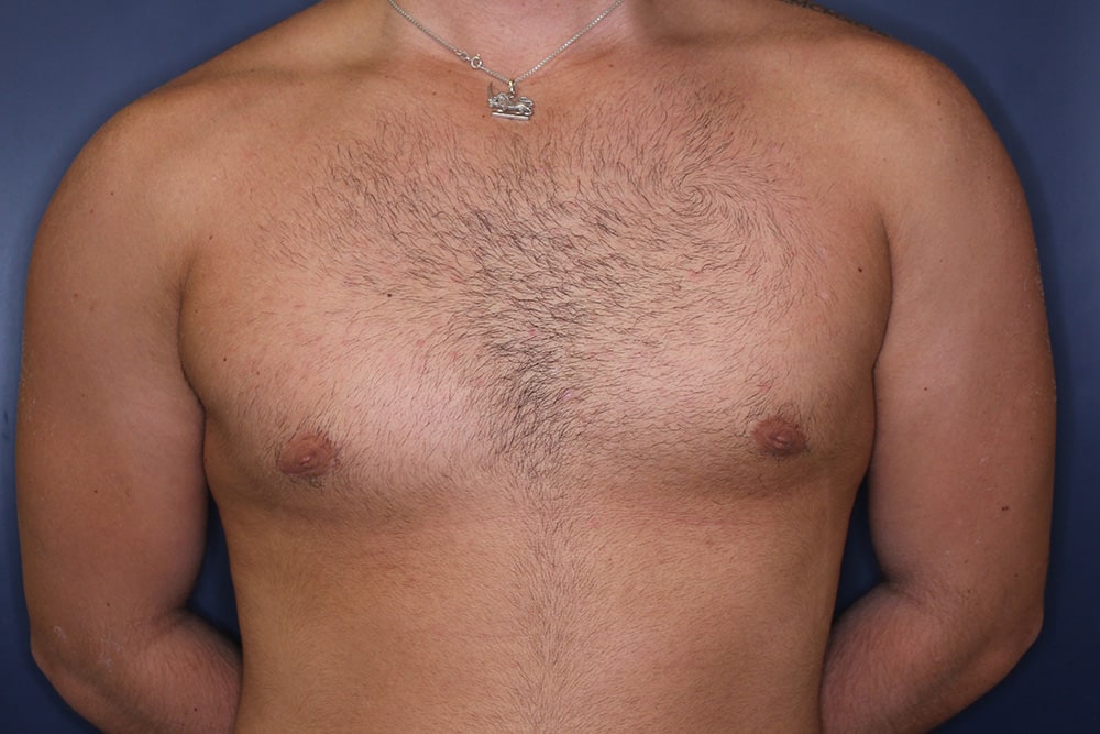 Gynecomastia Before & After Image