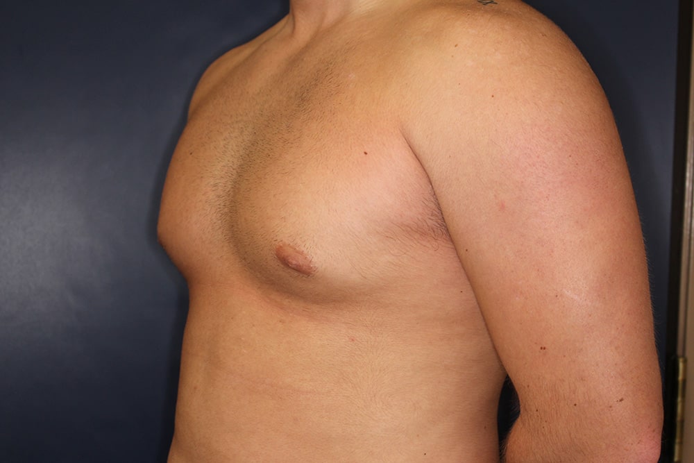 Gynecomastia Before & After Image