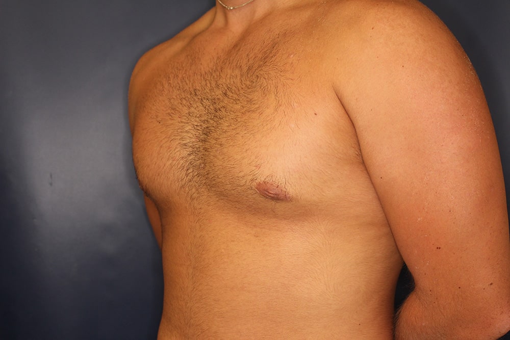 Gynecomastia Before & After Image