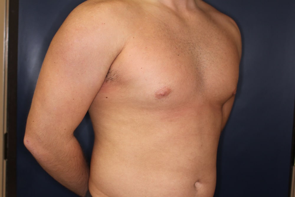 Gynecomastia Before & After Image