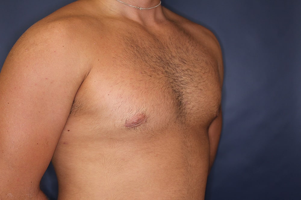 Gynecomastia Before & After Image