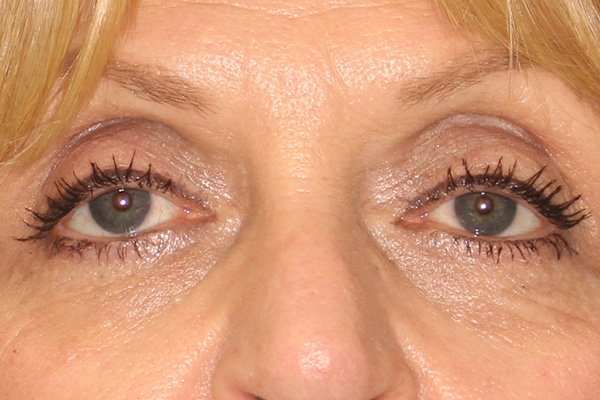 Blepharoplasty Before & After Image