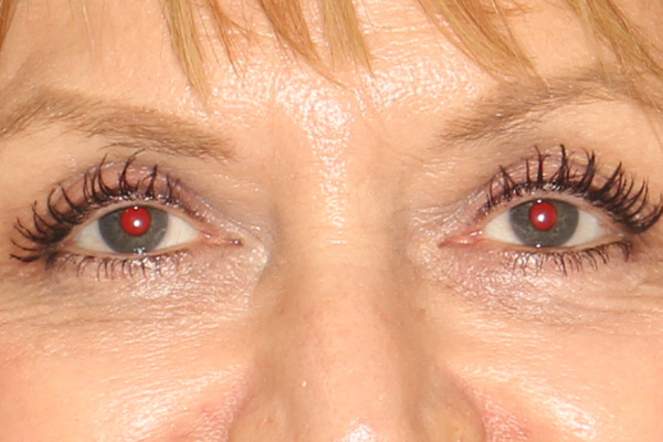 Blepharoplasty Before & After Image