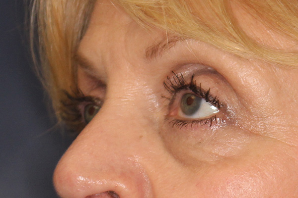 Blepharoplasty Before & After Image