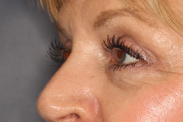 Blepharoplasty Before & After Image