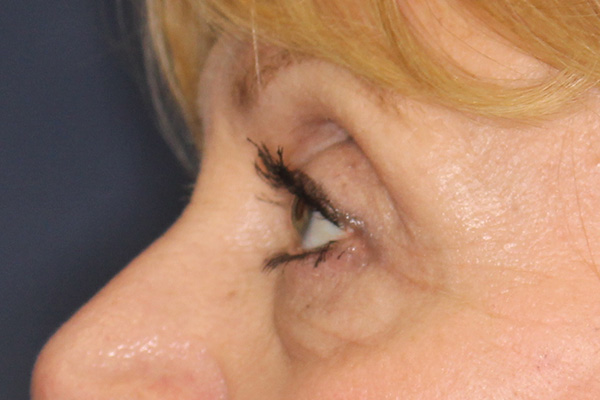 Blepharoplasty Before & After Image