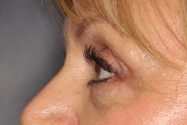 Blepharoplasty Before & After Image