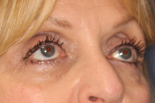 Blepharoplasty Before & After Image