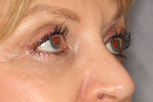 Blepharoplasty Before & After Image