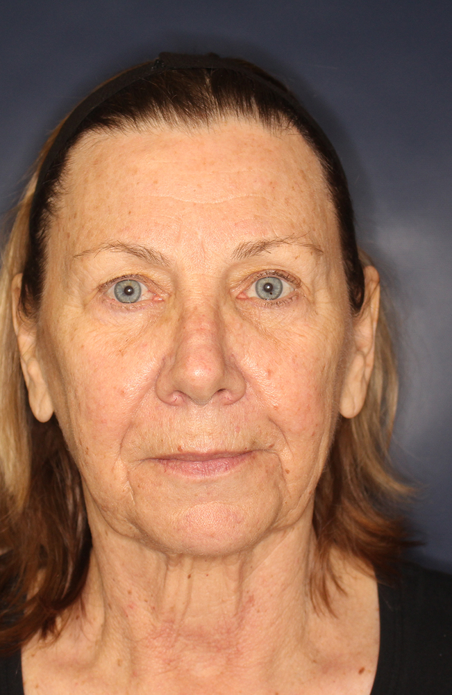 Blepharoplasty Before & After Image