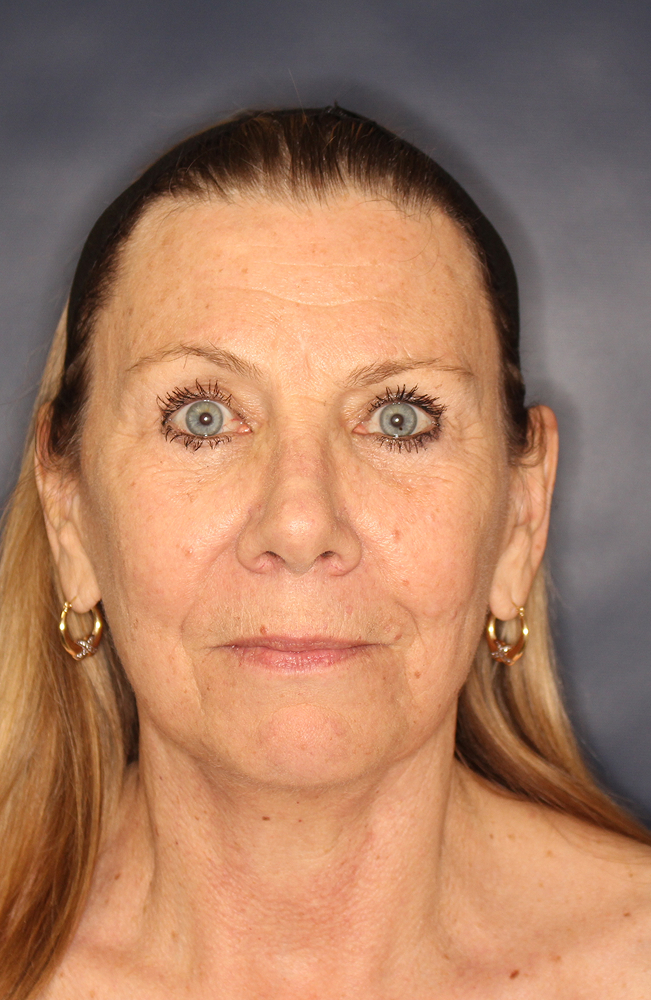 Blepharoplasty Before & After Image