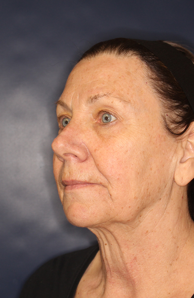 Blepharoplasty Before & After Image