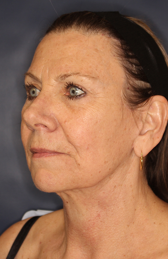 Blepharoplasty Before & After Image