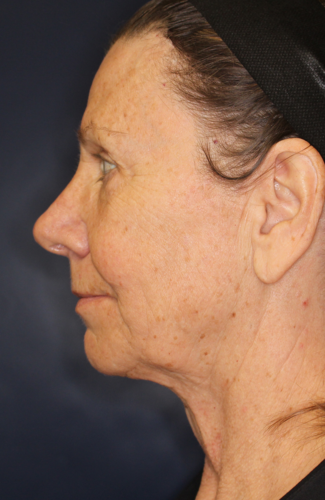 Blepharoplasty Before & After Image