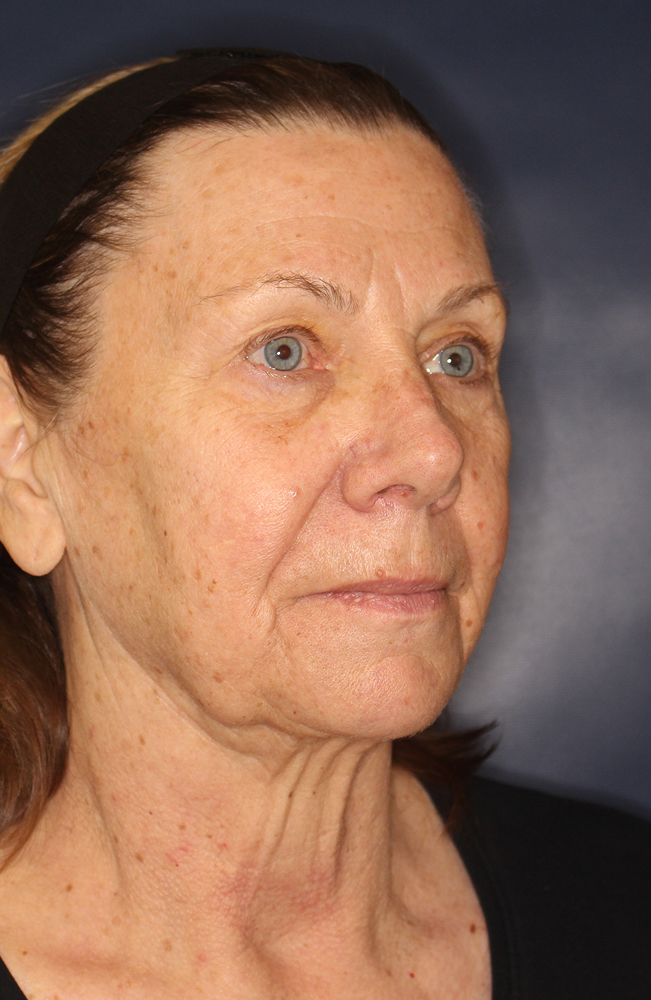 Blepharoplasty Before & After Image