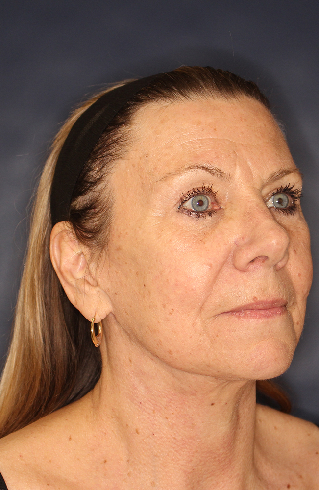 Blepharoplasty Before & After Image