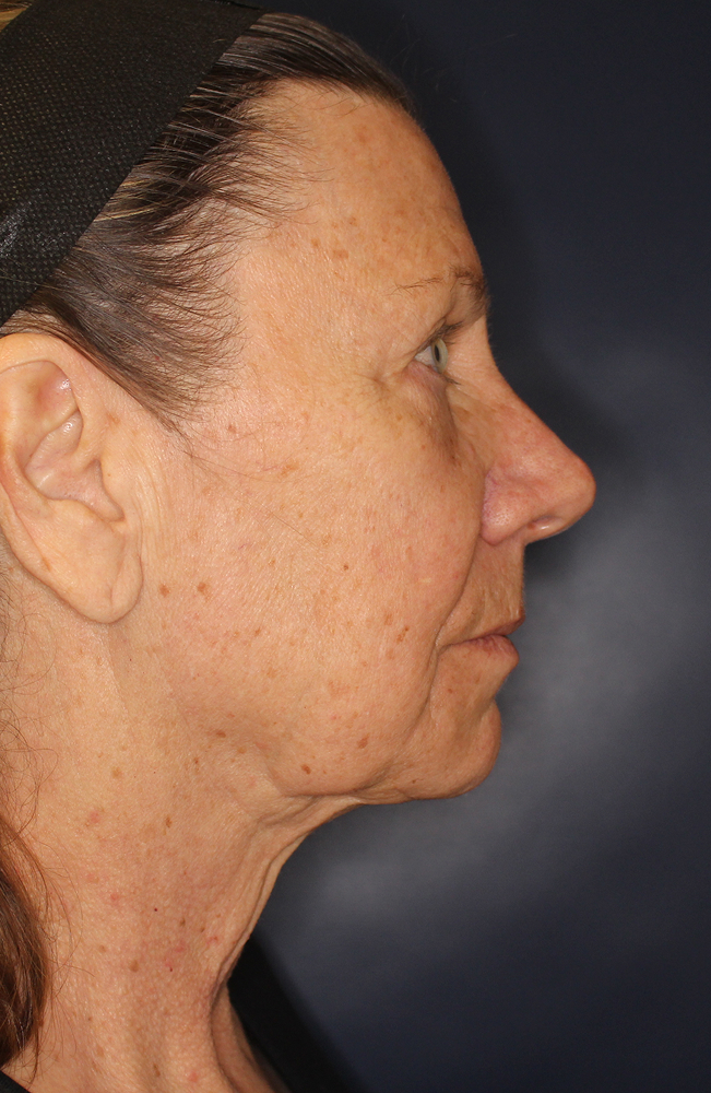 Blepharoplasty Before & After Image