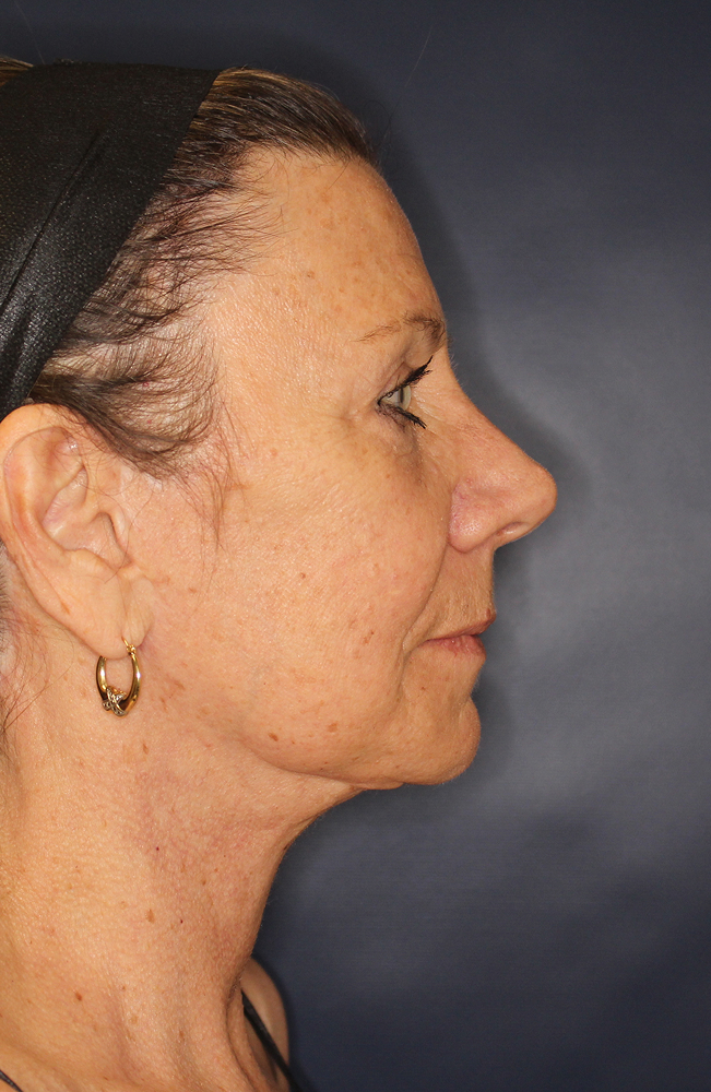 Blepharoplasty Before & After Image